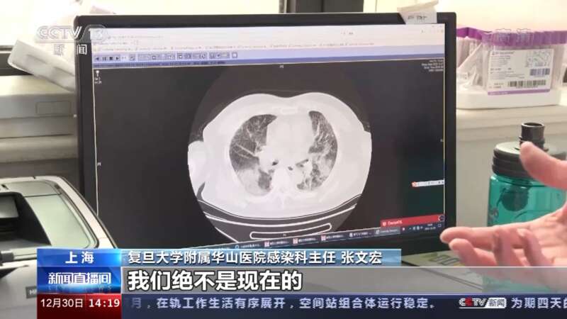 张文宏表示，尽管奥密克戎引起重症肺炎的比例低，但是因为感染人口基数大，出现“白肺”也就是重度肺炎患者 ...